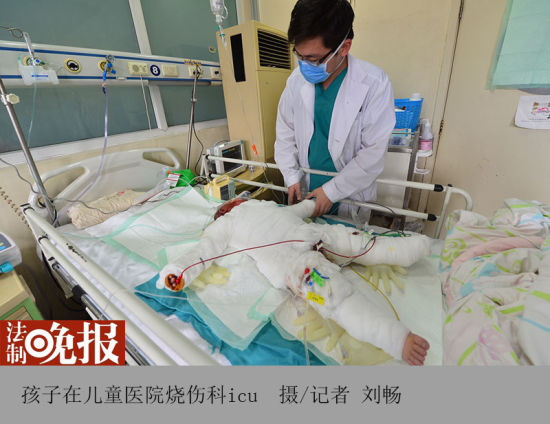 2歲男童掉入湯鍋大面積燙傷