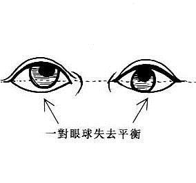 八卦命理：眼球不平的人一生坎坷(图)