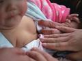女嬰雙側乳房“發育”