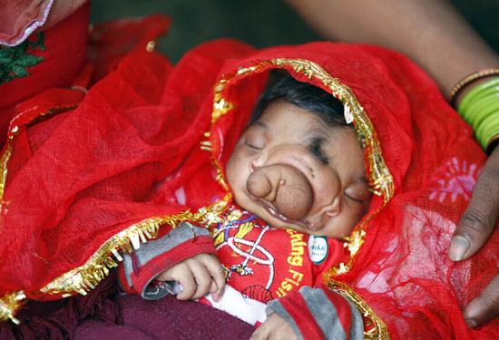 “象鼻”女婴