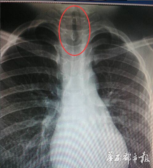 蚂蝗“蜗居”男孩喉咙