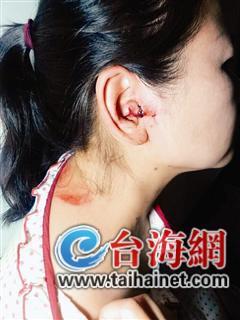 吴女士的外耳被砸伤