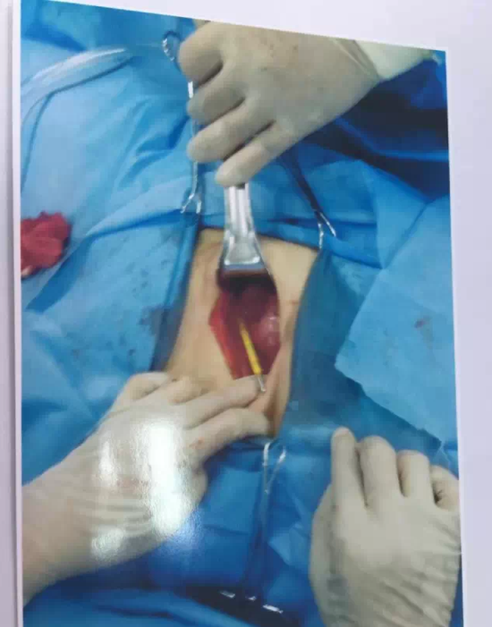 兰西女子肚疼11年 竟因腹腔有个体温计