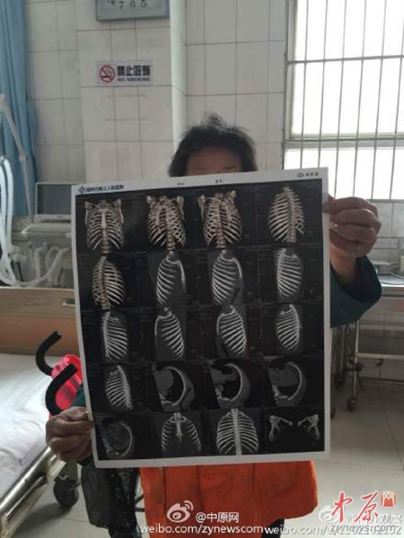 醫(yī)院診斷環(huán)衛(wèi)工有四根肋骨骨折