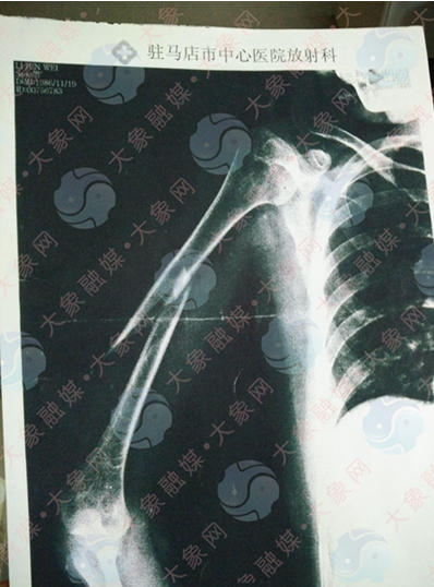驻马店中心医院X光照片显示，李安右胳膊一处明显骨折