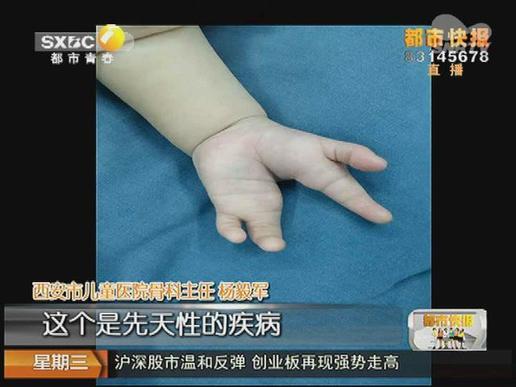 一岁男童长出“龙虾手”