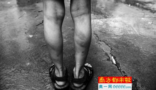 被打后4天,李某宇小腿后侧的伤痕隐约可见。南都记者 梁炜培 摄