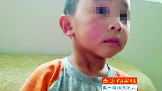 被老师用筷子打,孩子脸上与腿上留下痕迹。南都记者 何永华 翻拍