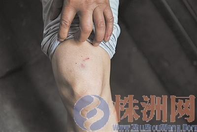 ▲5月17日,金先生的左腿被狗咬伤 记者 谢慧 摄