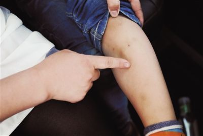 一名孩子展示腿上被老师打出的淤血
