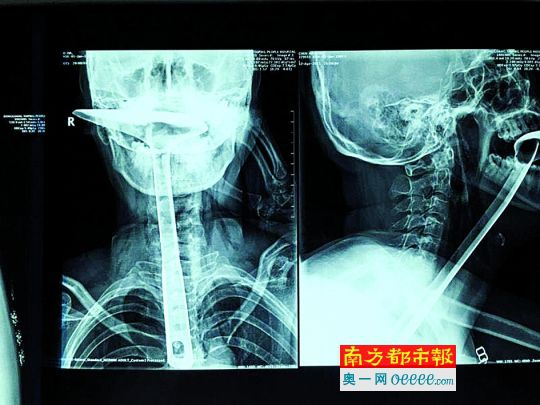 患者拍片显示锅铲插入食道直抵右胸。