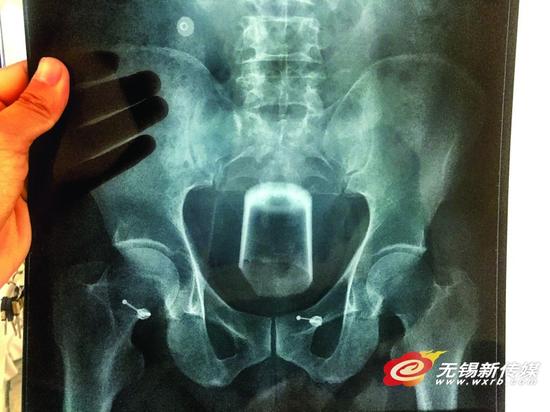 X光片显示该男子直肠壶腹内有只杯口破损的玻璃杯。