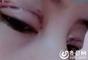 恢复了一个多月之后，两人眼皮仍然下垂，而且影响睁眼。（视频截图）