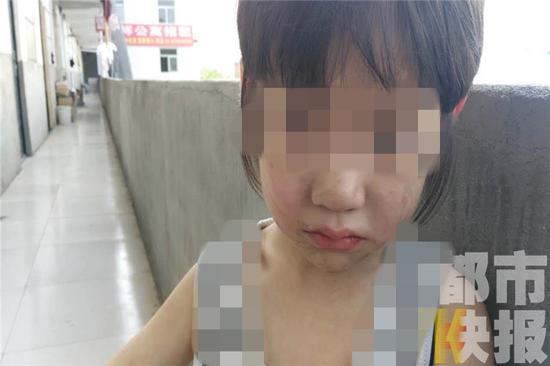 四歲童被母親暴打