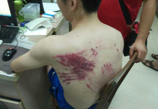 据悉目前伤者暂无生命危险,初步诊断为脑震荡。