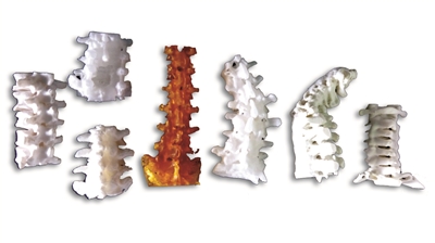 3D打印胸椎模型 模拟手术减风险|3D打印|胸椎