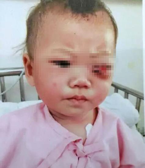 商丘10月大寶寶被爸爸戳瞎眼