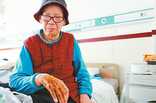 老人自己在手上涂抹药膏，说病还没好，不想出院。 记者黄黎摄□本报记者黄黎