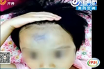 视频：3岁女孩疑遭保姆虐待满身淤青 保姆矢口否认