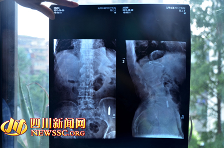 达州94岁抗战老兵体内藏子弹 原因至今成迷