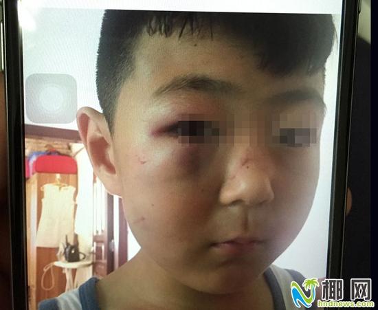 图为受伤孩子小赵(家长供图)