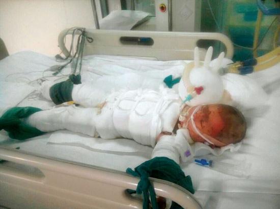 兩歲多的小靈犀在鄭州市第一人民醫(yī)院燒傷科治療