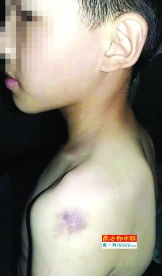 孩子手臂出现淤青。南都记者 唐建丰 摄