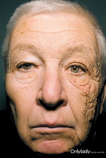 图中的老人是一名卡车司机，面部肌肤长期接受了不均匀的太阳光照射。