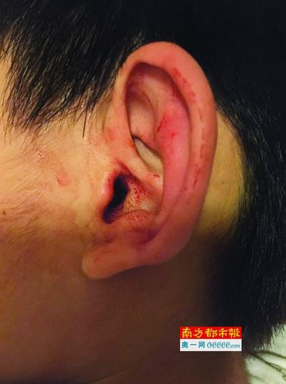 5岁半的小麟左耳出血,原因至今还未有定论。受访者供图