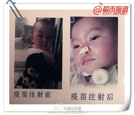 幼童接種疫苗 成為植物人