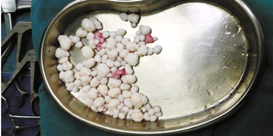 宁波30岁男子肩膀里长满肿瘤 手术取出111颗