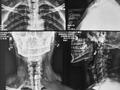 从X光片可以看见黎女士喉咙中的异物。