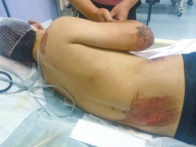 被撞少年傷勢(shì)嚴(yán)重，正在醫(yī)院接受救治。