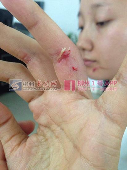 陈女士的脸部,手都受伤了