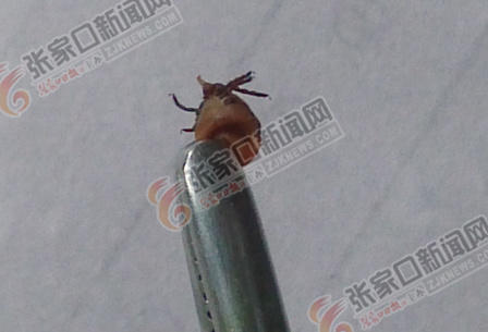 经治疗后成功将蜱虫取出来。