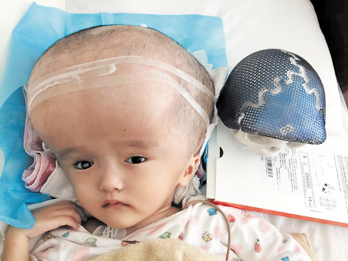 术前涵涵的头颅和正常头颅模型的对比。