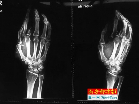女医生欧丽志右手的C T图,食指部位有明显的砍伤痕迹。通讯员供图