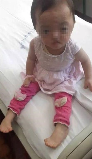 漯河雙胞胎女孩患怪病