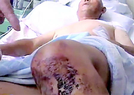吴先生的膝盖被小偷拖出了伤。