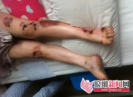 受害人小丽被拖行200多米,全身是伤。