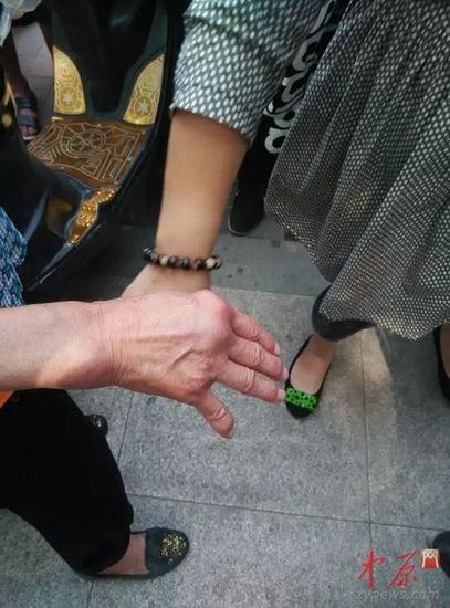 62歲環衛工，食指上方被人用掃帚棍毆打出了1個大包。