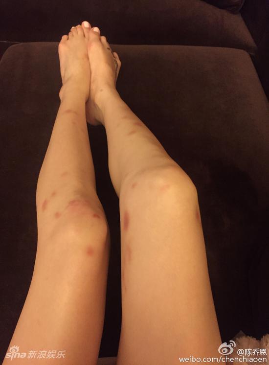 陈乔恩腿上淤青