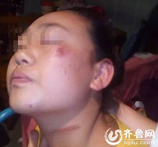 近日,新泰小姑娘嘉鈺在去接妹妹的路上,被一根垂落的網線勒到脖子,摔暈在路上。(齊魯頻道記者供圖)