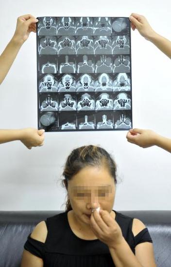 CT显示,李素的鼻子已经变形了。2013年,李素到成都一家美容整形医院进行隆鼻整形,后由于感染开始维权。