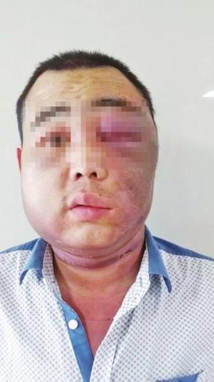 壮汉遭蚊子叮一口面部肿成球 半月后大大消肿