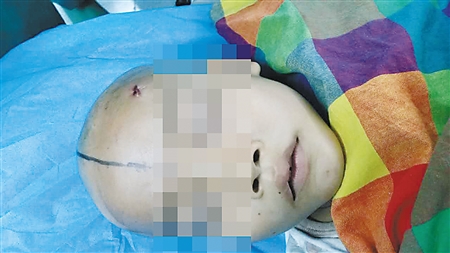 8岁男孩玩警察抓小偷 头部差点被玩具枪钢珠打