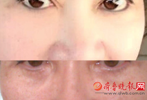 上图:泪沟充填前,周女士的眼部。 下图:近两年过去,周女士的眼部下方仍然可见青黑色突起。周女士 提供