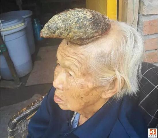 资阳老太头上长5厘米皮角 检查无具体结果