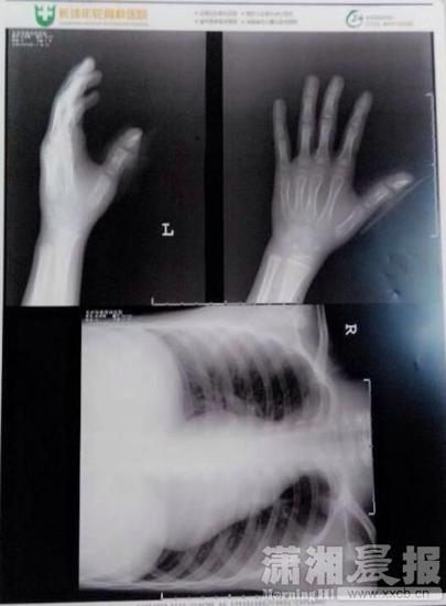 孩子左手的X光片。