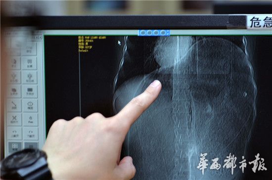 医生展示王涛的X光片，心脏被巨型结肠挤压